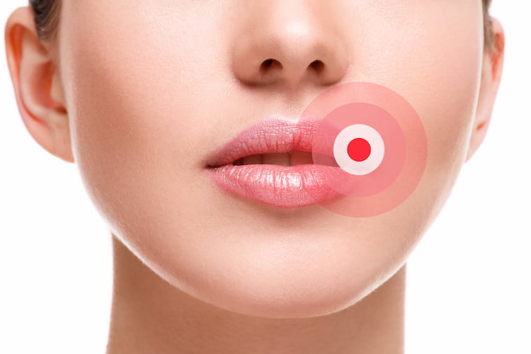 What to use for a cold sore on your lip Cold Sore Removal Sherwood Dental