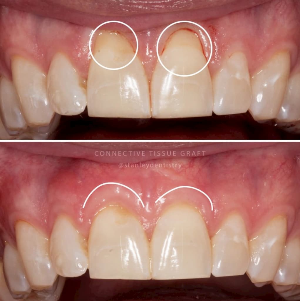 receding gums surgery before and after