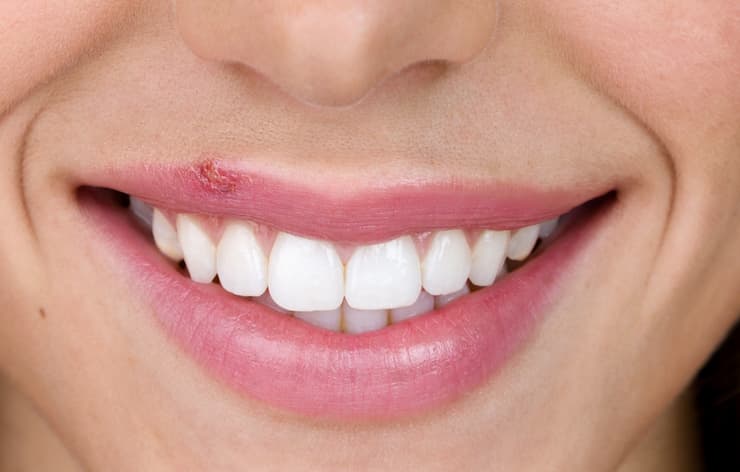 Should You Pop A Cold Sore What To Do Oral Care